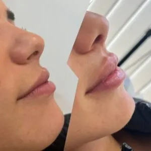 aumento de labios almeria