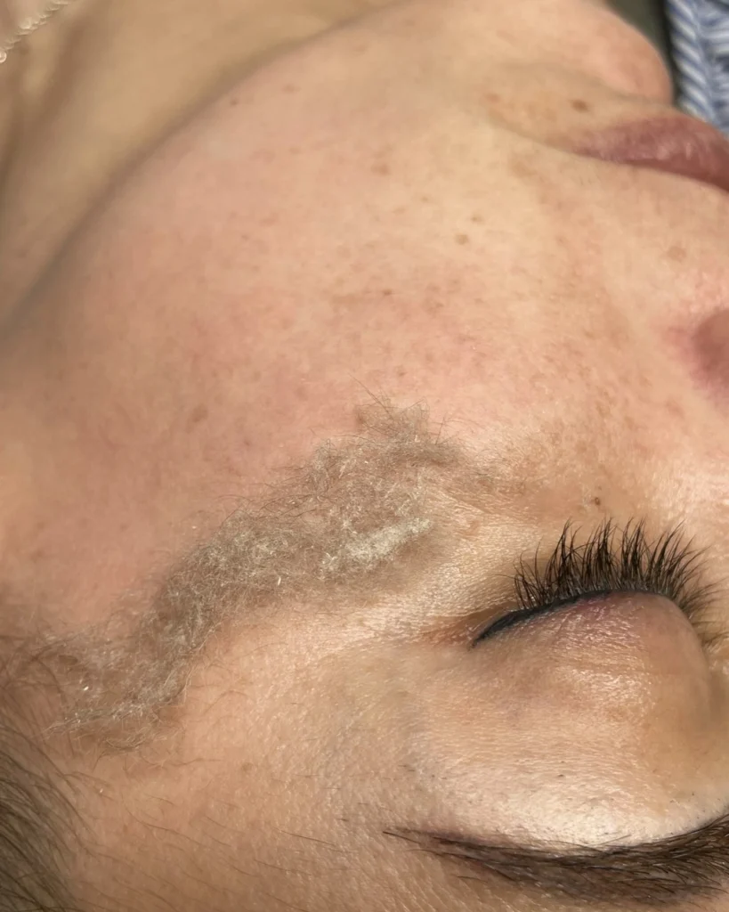 Dermaplaning en Almería