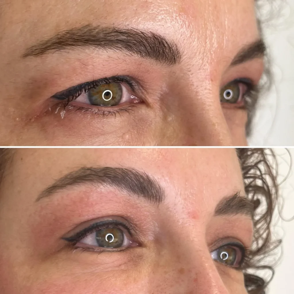 Blefaroplastia Almería
