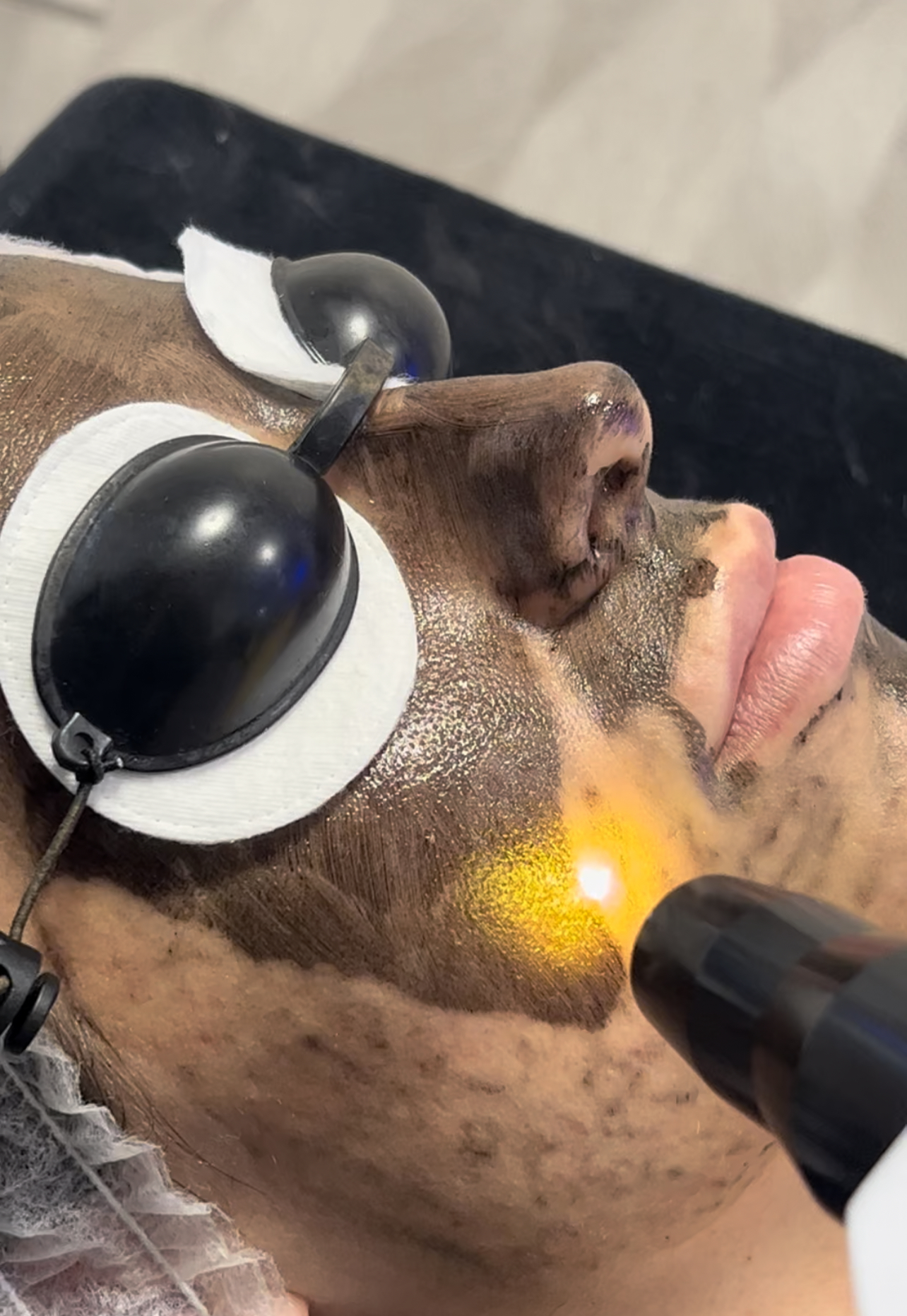 Peeling Carbon Activo Almeria