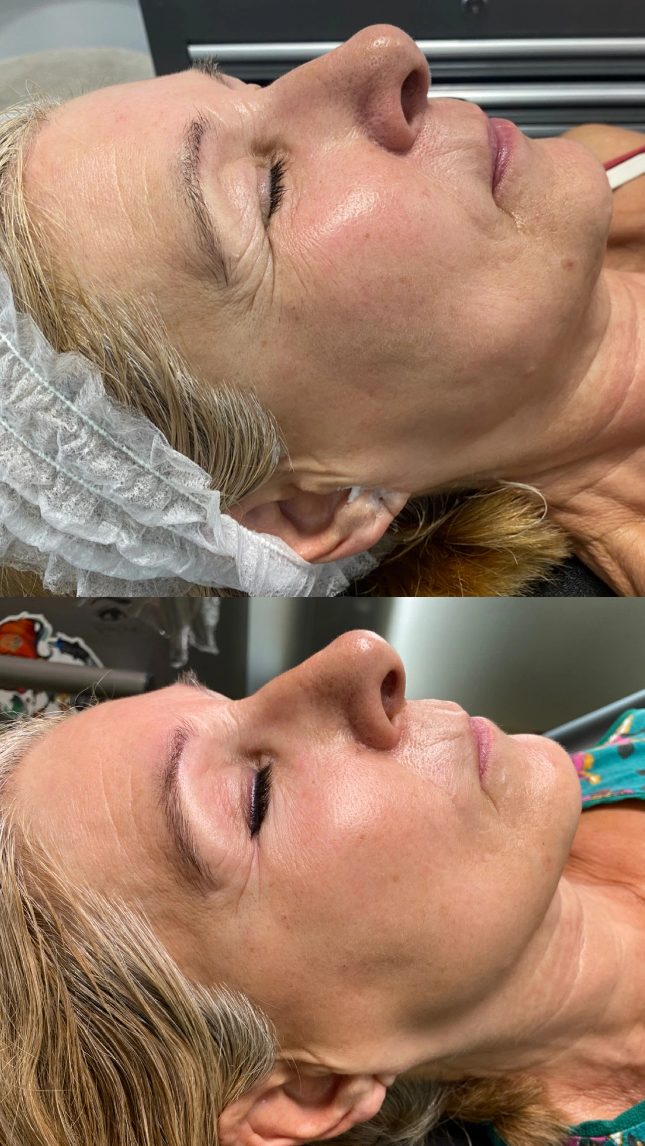 Radiofrecuencia Diatermia Almeria