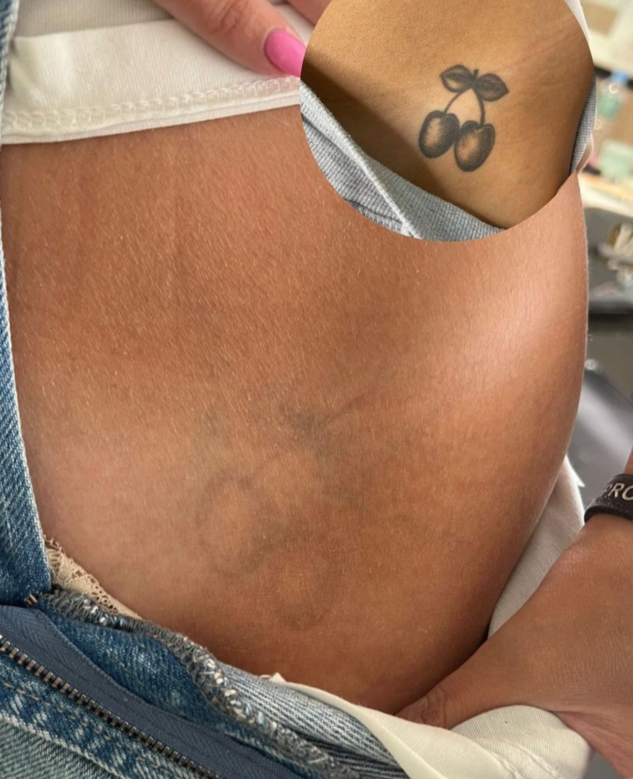 eliminación tatuajes almeria