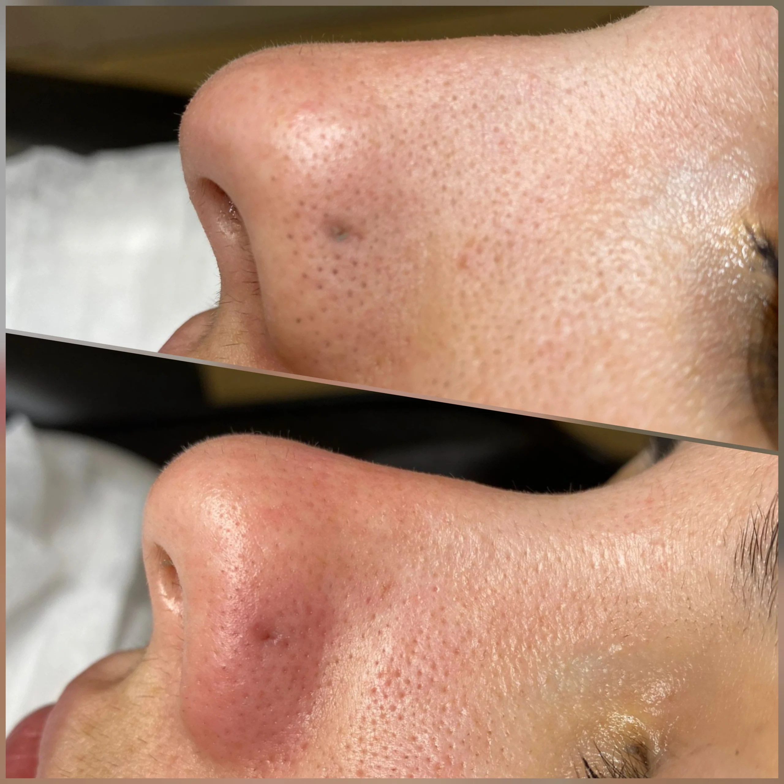 Resultados hidra skin pro