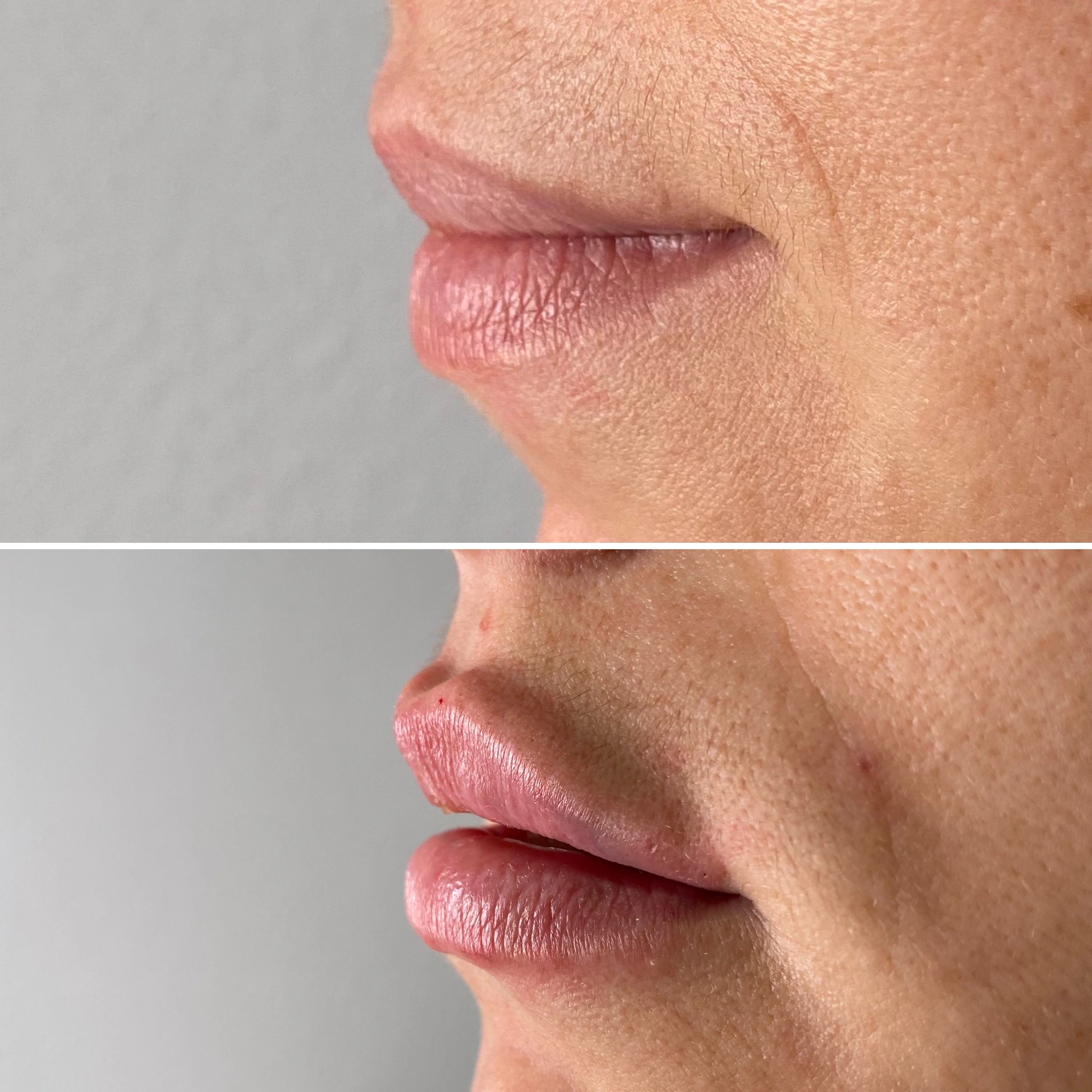 Aumento de labios almería