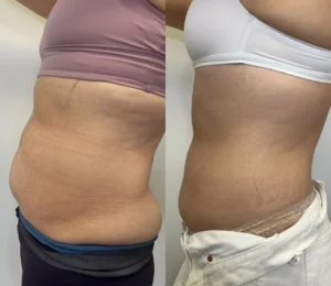 Mesoterapia Corporal