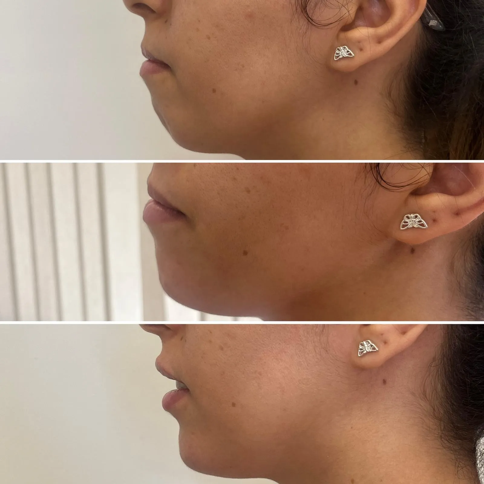 Aumento de mentón en Almería