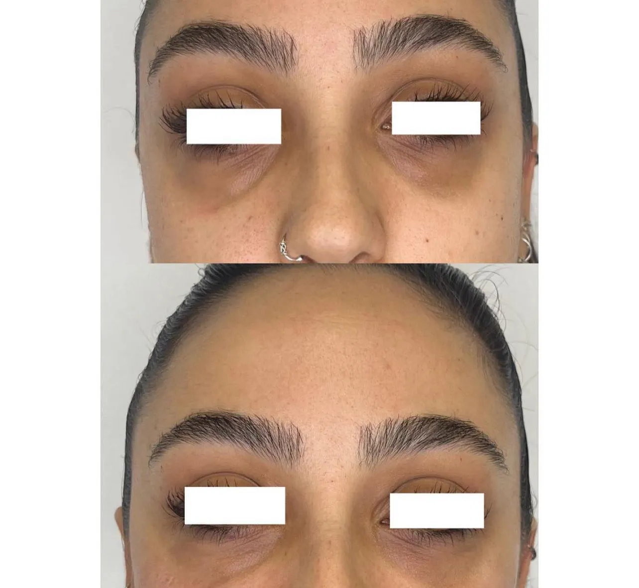 Tratamiento Ojeras Almería