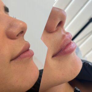 aumento de labios almeria