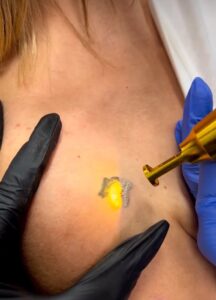 eliminación de tatuajes en almeria