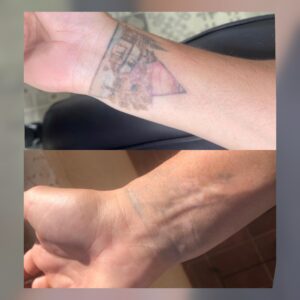 eliminación de tatuajes en roquetas de mar