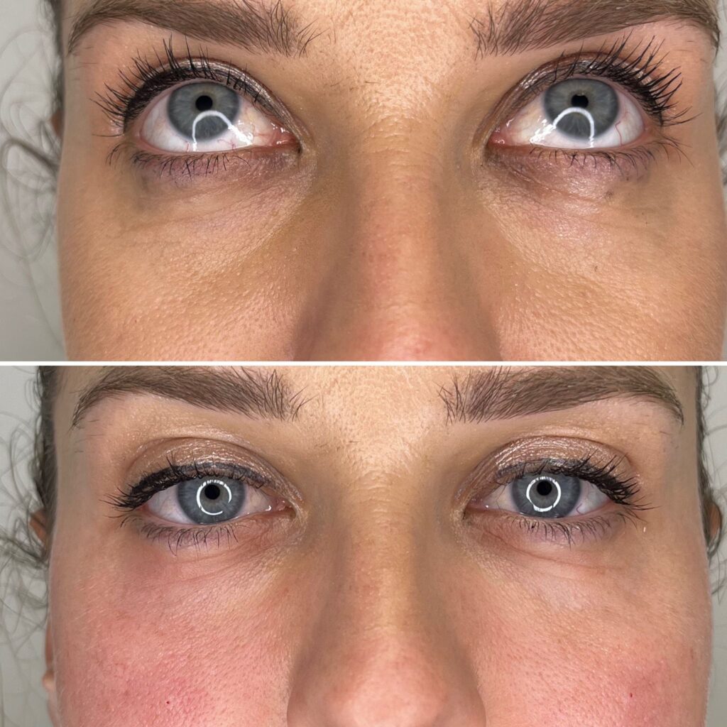 Eliminar ojeras en roquetas de mar