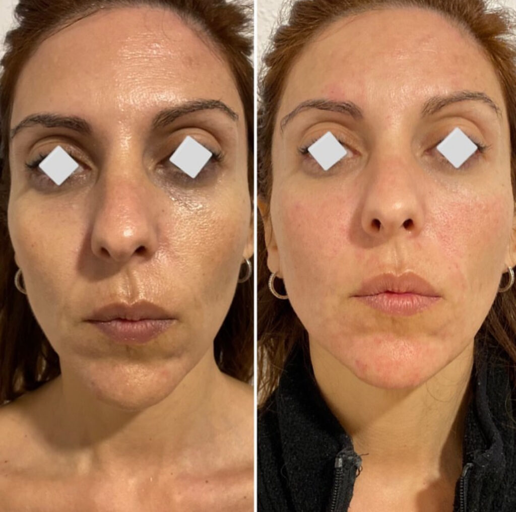 Mesoterapia facial Almería