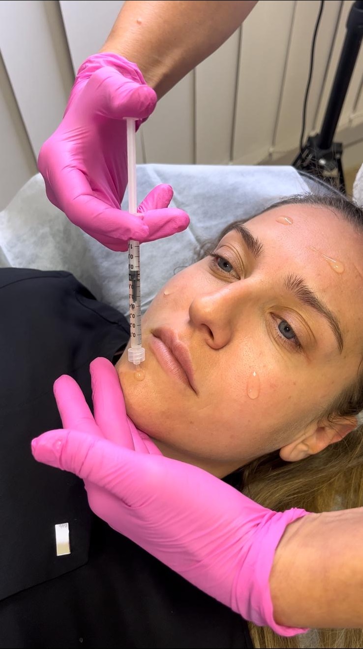 Peeling Químico en Almería