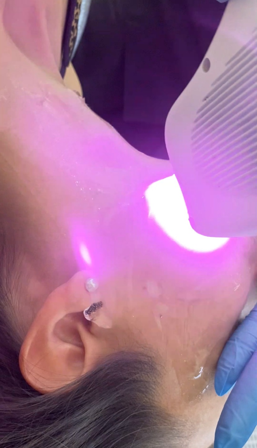 rejuvenecimiento facial con láser en almeria