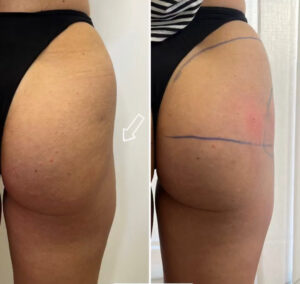 remodelación de gluteos en almeria