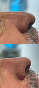 Rinomodelación en roquetas