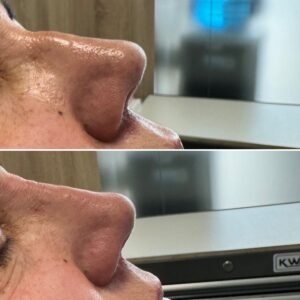 Rinomodelación en almeria